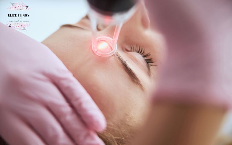 Laser Melasma treatments