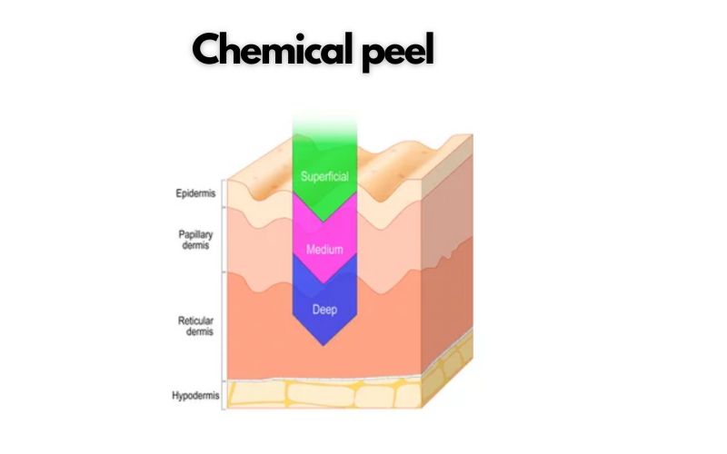 Chemical peel in Gurgaon