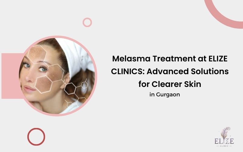 melasma treatment in Gurgaon