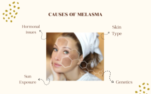  melasma treatment in Gurgaon