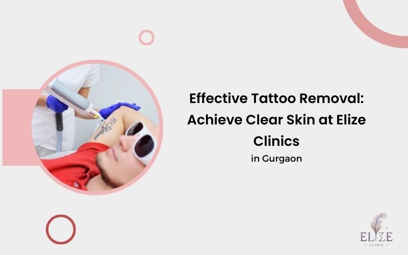 Tattoo Removal in Gurgaon