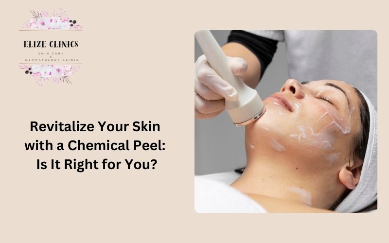 chemical peel treatment in gurgaon