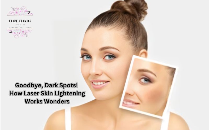 Laser skin lightening