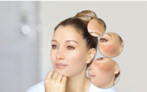 melasma treatments